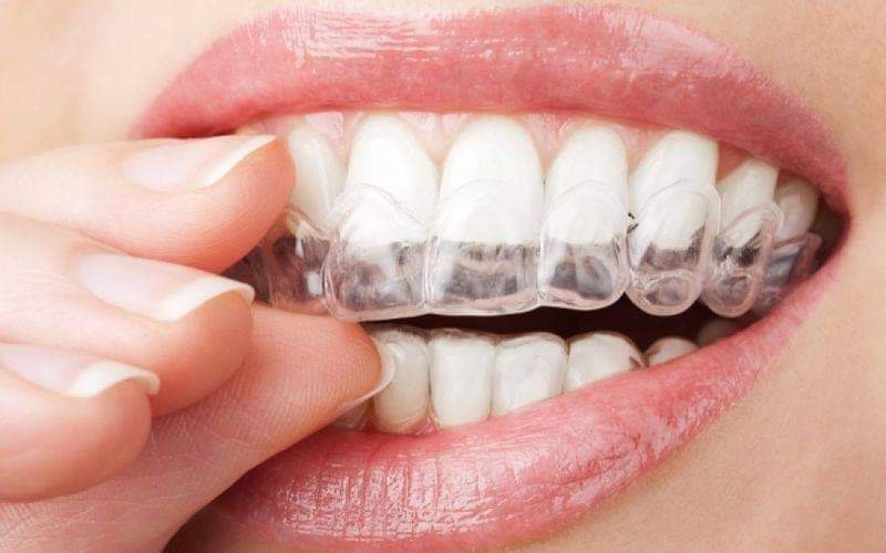 Μύθοι και αλήθειες για την οδοντική λεύκανση